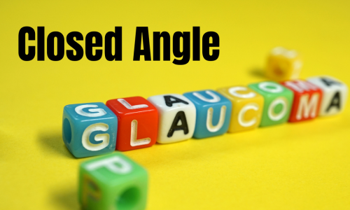 Closed Angle Glaucoma Featured