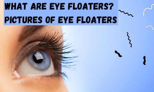 Pictures Of Eye Floaters Featured