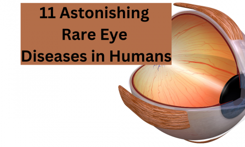 11 Astonishing Rare Eye Diseases in Humans 9 11 Astonishing Rare Eye Diseases in Humans