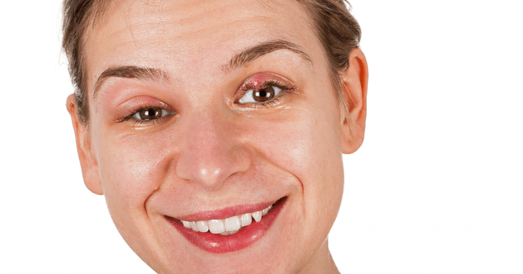 Best 7 Ways to Quickly Get Rid of a Stye! 7 Get Rid Of A Stye