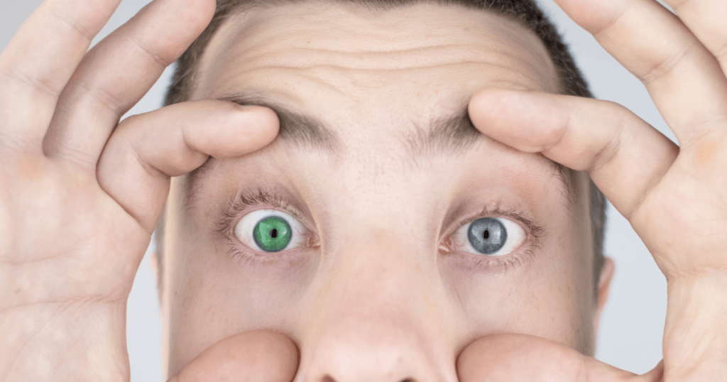 Heterochromia Iridis Is A Rare Eye Condition
