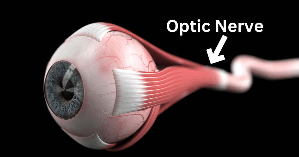 Neuromyelitis Optica (Devic Disease) Optic Nerve