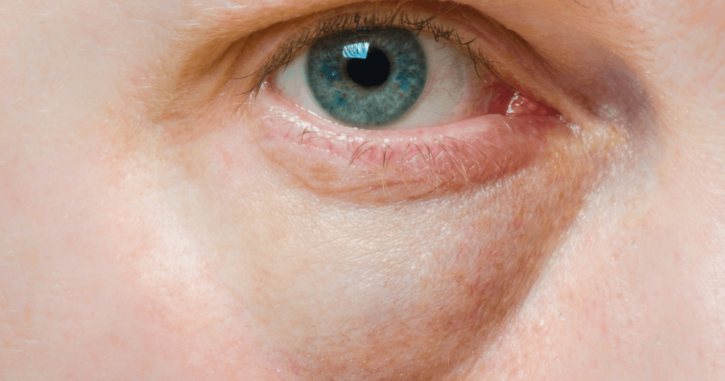 Under Eye Bags