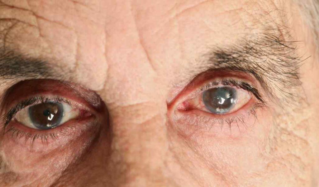 Cataracts