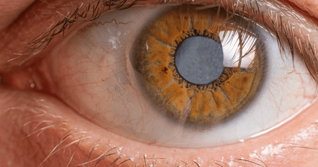 Cataracts the second of the 4 most common eye problems
