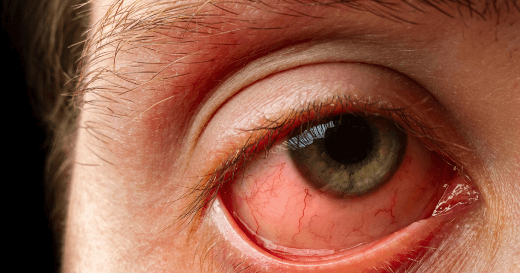 Diabetic Retinopathy is the third of the 4 most common eye problems