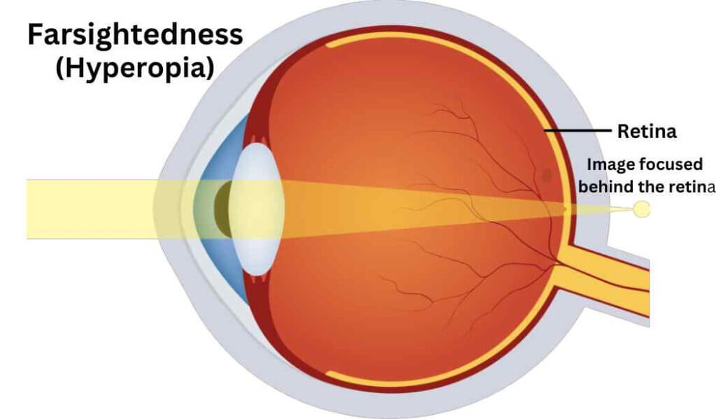 Farsightedness (Hyperopia)
