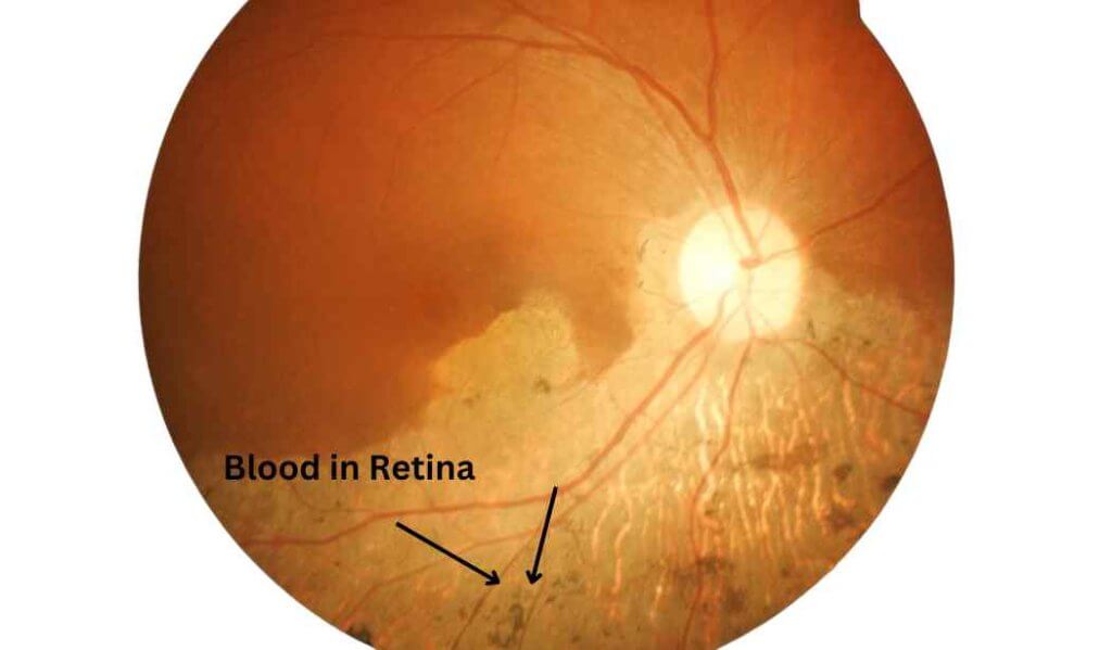 Macular Edema