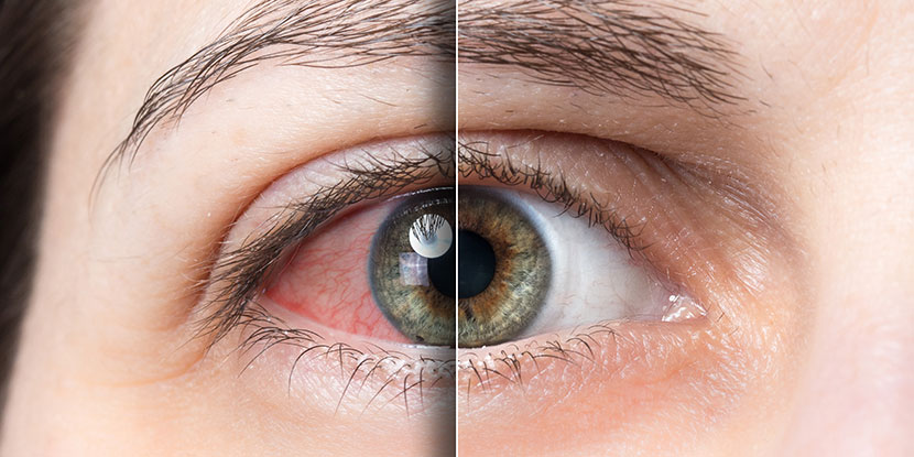 Alleviating Dry Eye Syndrome
