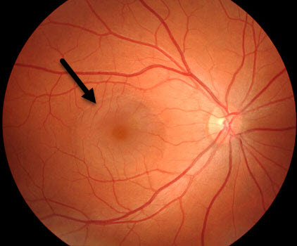 Dry Eyes - Impact of Stress on Eye Health