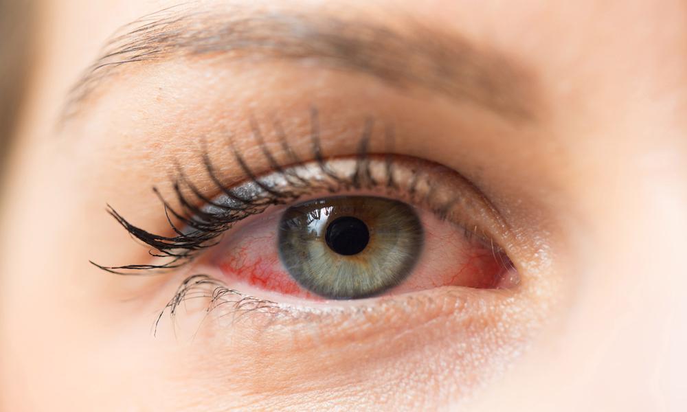 Dry Eyes - Impact of Stress on Eye Health
