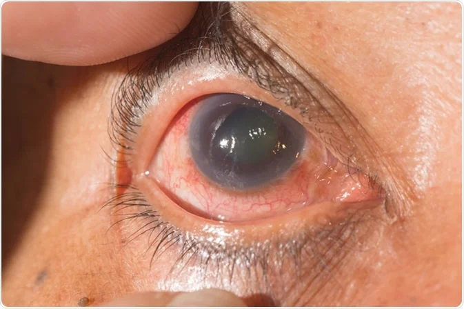 Glaucoma - Impact of Stress on Eye Health