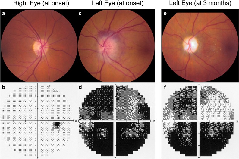 Optic Neuropathy - Impact of Stress on Eye Health