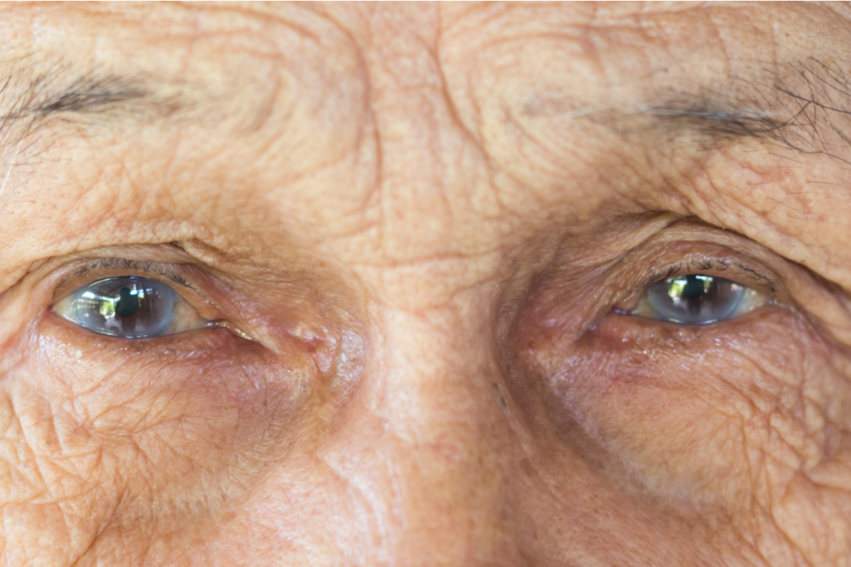 Stress-Induced Cataracts - Impact of Stress on Eye Health